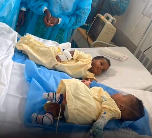 Angola celebra marco histórico com cirurgia rara de separação de gémeas siamesas