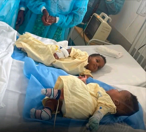 Angola celebra marco histórico com cirurgia rara de separação de gémeas siamesas
