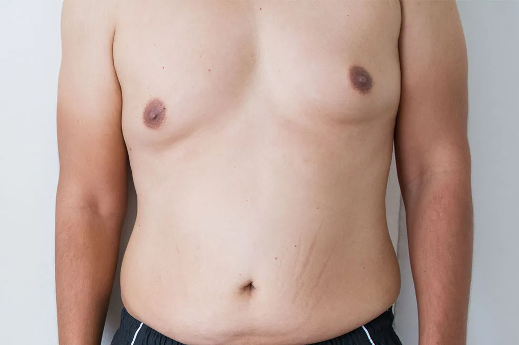 Gynecomastia botched job