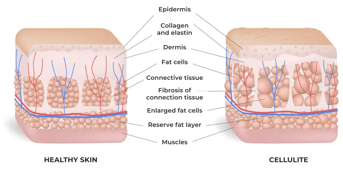 Cellulite skin vector