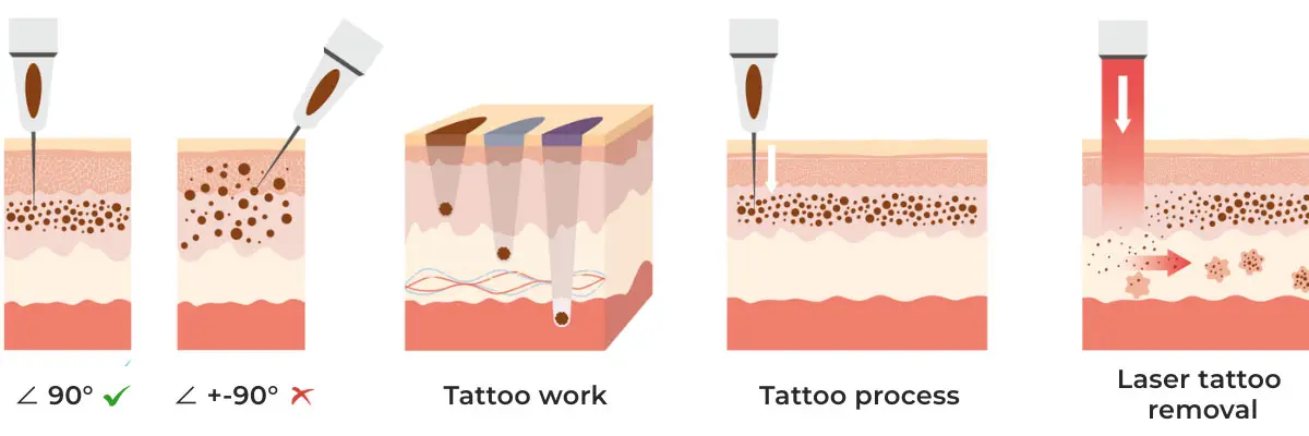 Tattoo Laser Removal vector