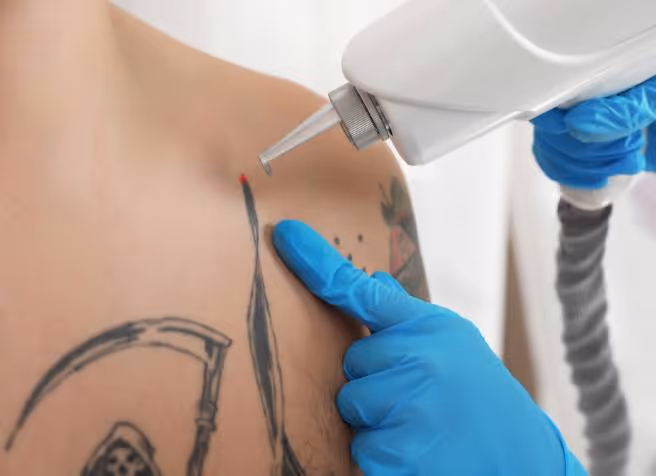 Picolaser Tattoo Removal