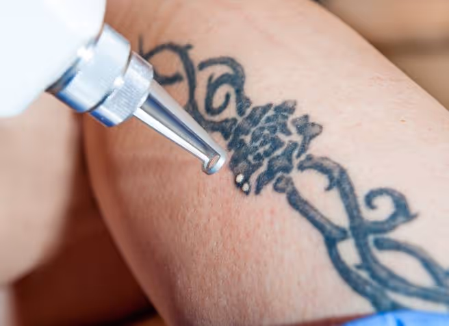 Picolaser Tattoo Removal