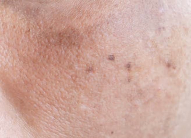Melasma