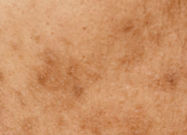 Post-Inflammatory Hyperpigmentation 