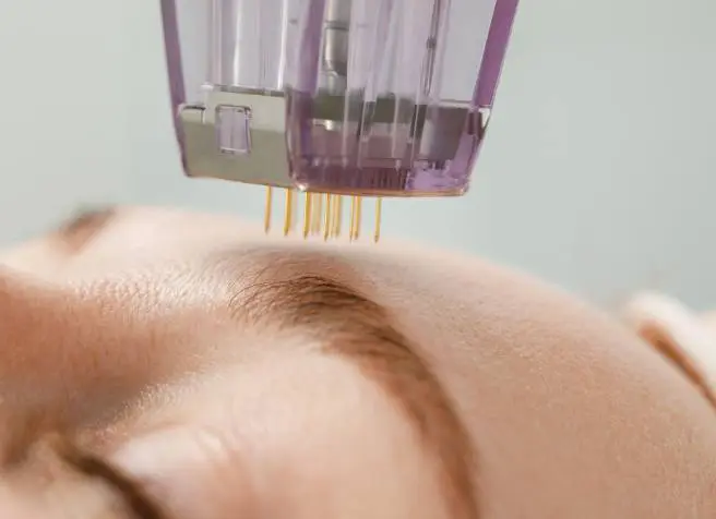 RF Microneedling