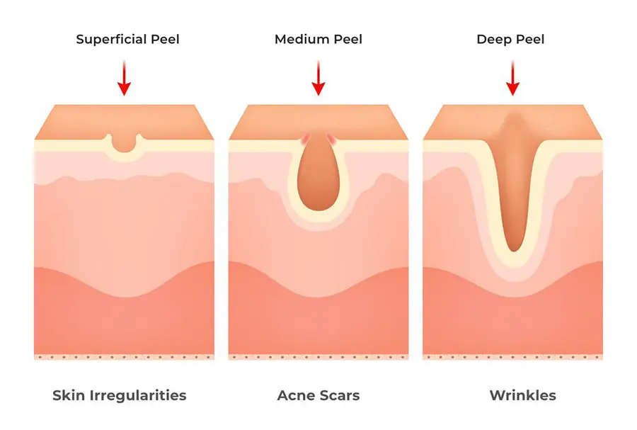 Types of chemical peels vector