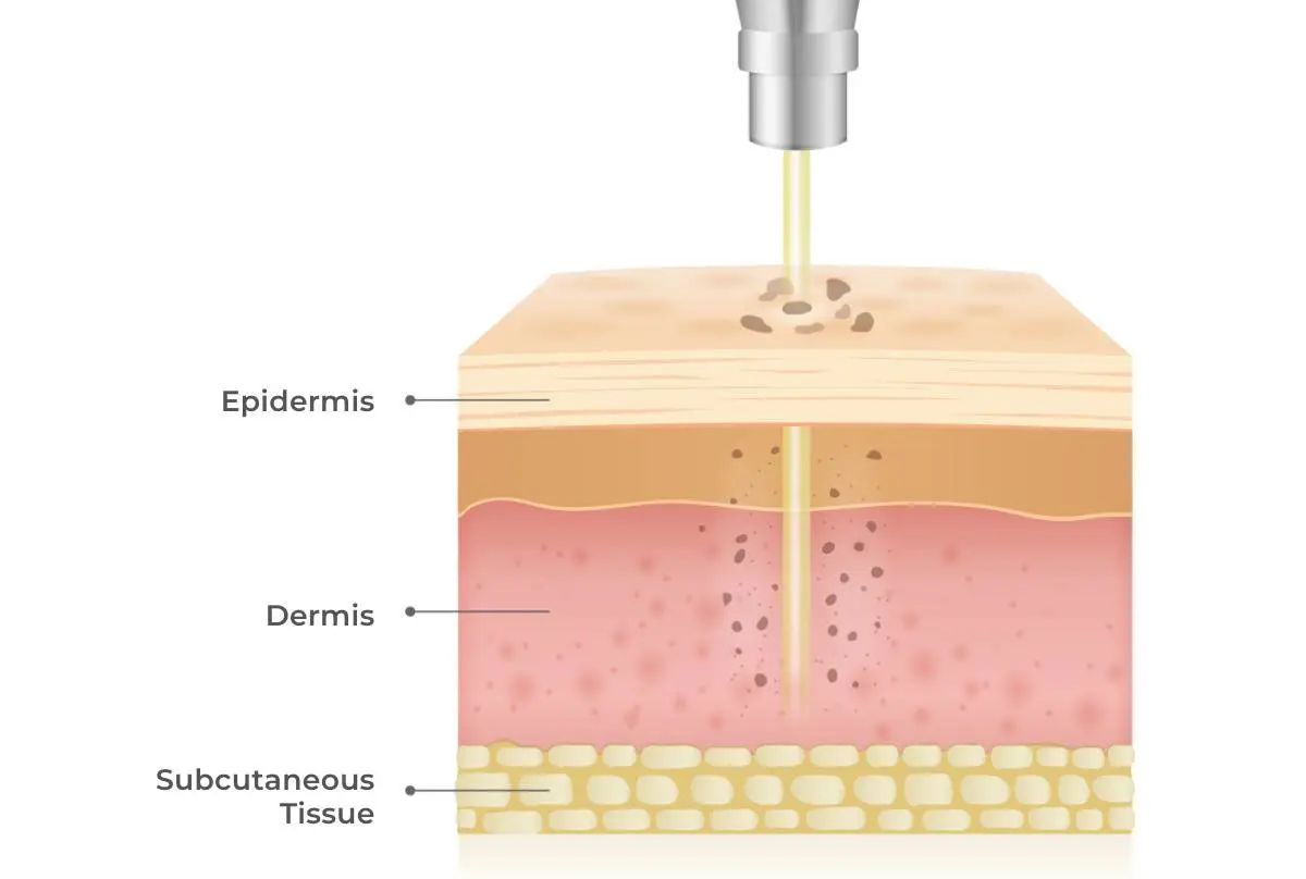 Pigmentation Laser how it works vector