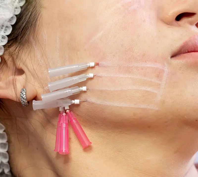 PDO thread lifting insertions