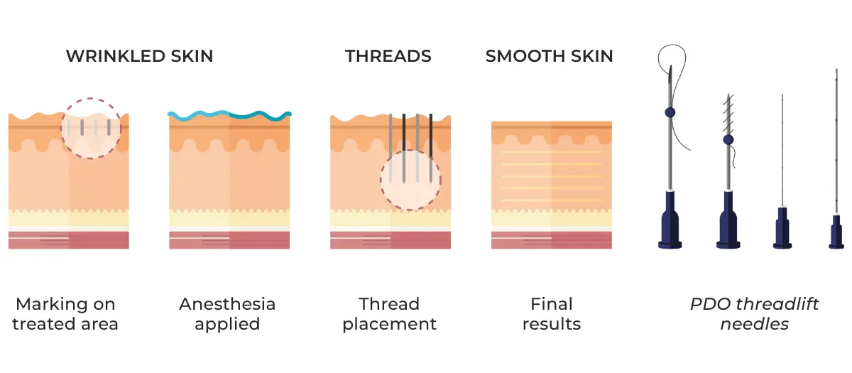 PDO Threadlift Process