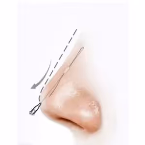 Base of the nose for threadlift