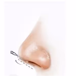 Base and tip of the nose for threadlift