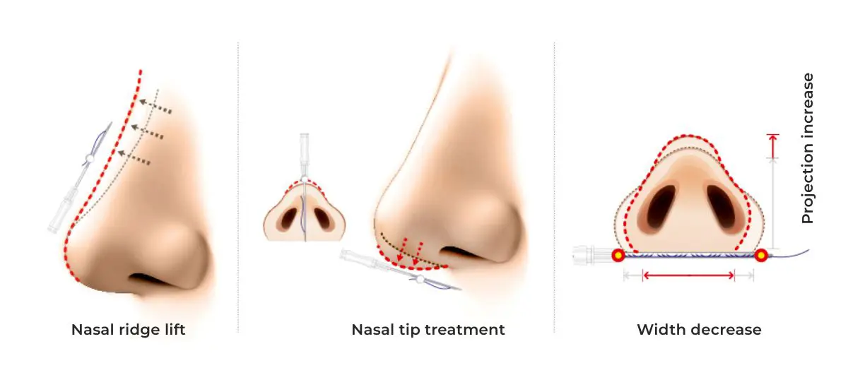 Nose treatments with threadlift