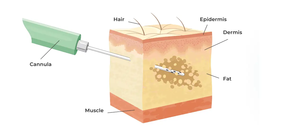 Laserlipolysis (Laser Liposuction)