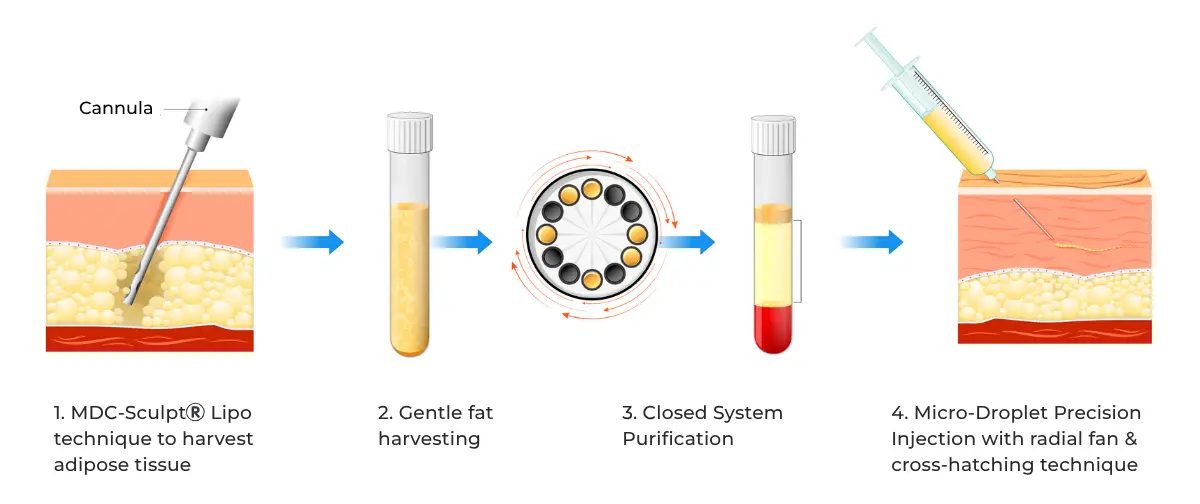 Fat grafting how it works