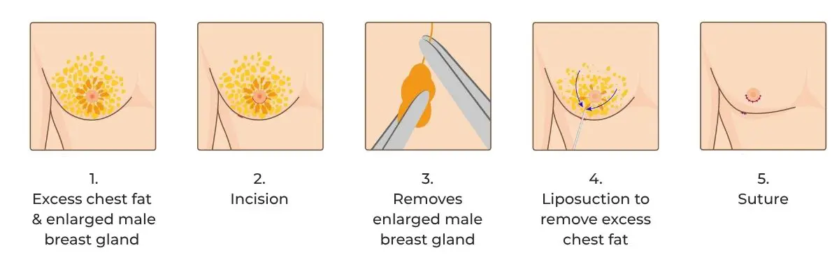 Gynecomastia Vector