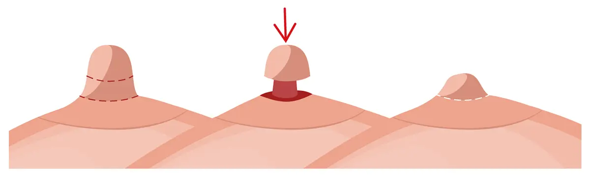Nipple reduction vector