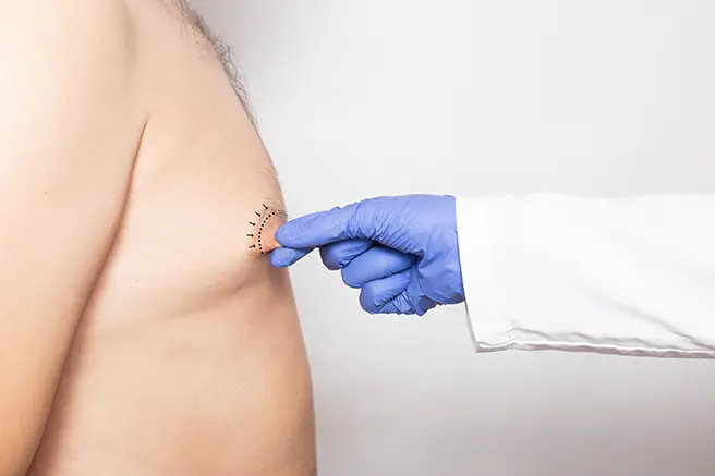 Nipple Reduction Surgery Singapore