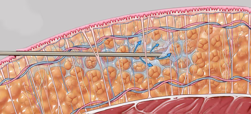 How Does Vaser Liposuction Work _ Infiltration