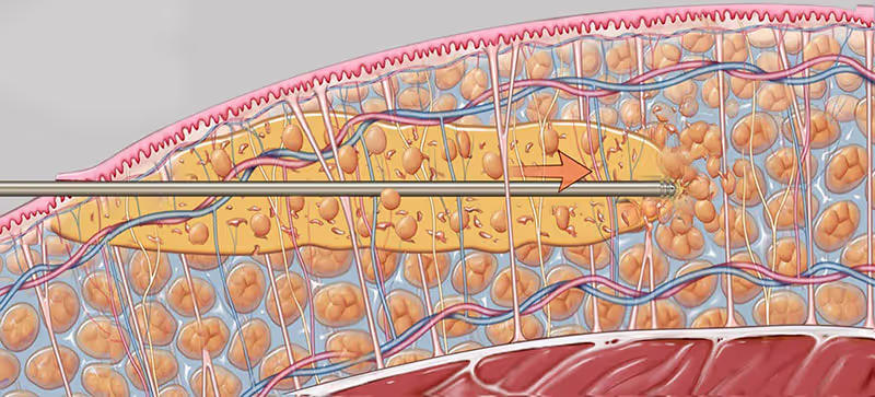 How Does Vaser Liposuction Work _ Ultrasound Delivery