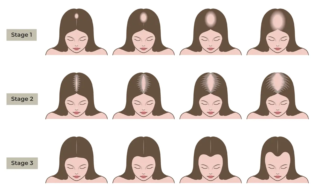 3 STAGES OF HAIR LOSS PATTERNS IN WOMEN - LUDWIG SCALE