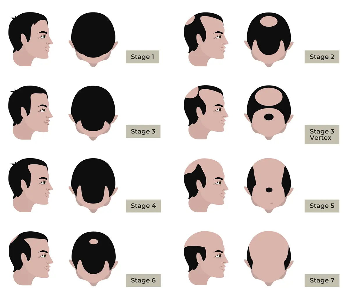 7 STAGES OF HAIR LOSS PATTERNS IN MEN - NORWOOD SCALE