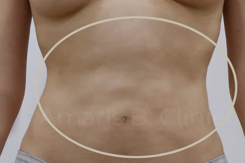 Case 1: Female. Had liposuction performed on the abdomen in Singapore. Unevenness, dents and lumpiness of the abdomen and uneven curve on the left body contour as seen in the picture, who seek liposuction correction surgery with Dr. Ivan Puah.