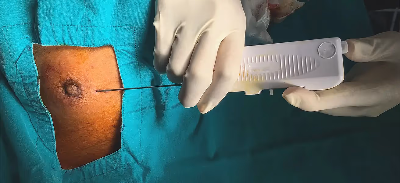 gyno surgery