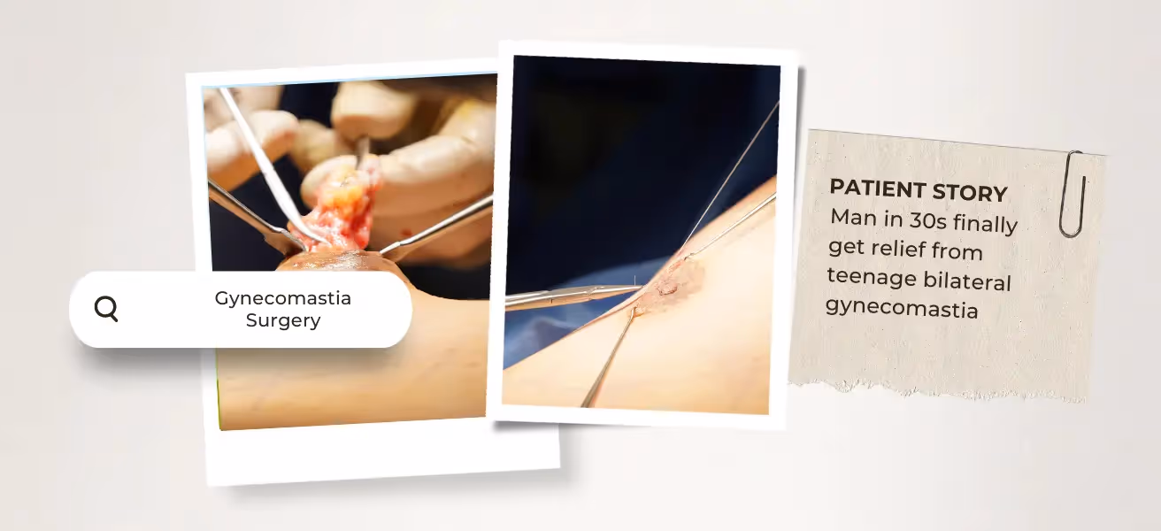 Man in 30s | Relief from teenage bilateral gynecomastia Singapore