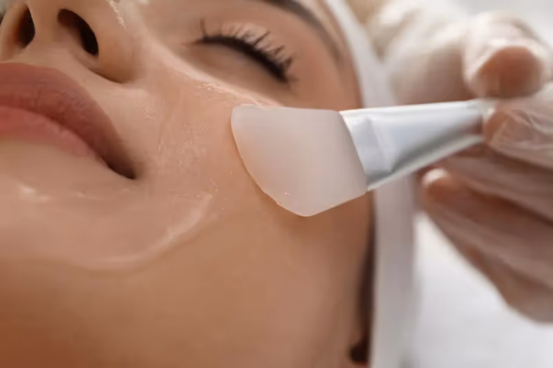Microneedling sans chemical peel is effective enough for treating atrophic acne scars Singapore