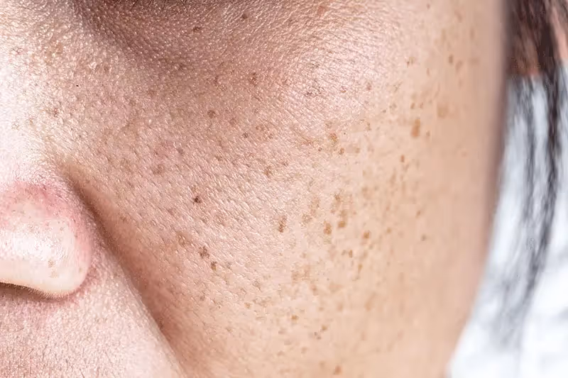 Age spots Singapore | Pico Fractional Laser Removes Hyperpigmentation in Asian Skin