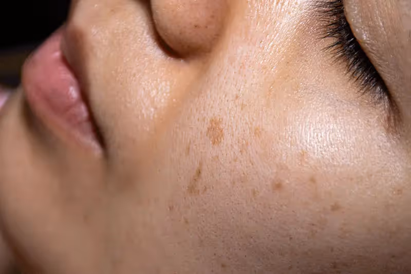 Freckles Singapore | Pico Fractional Laser Removes Hyperpigmentation in Asian Skin