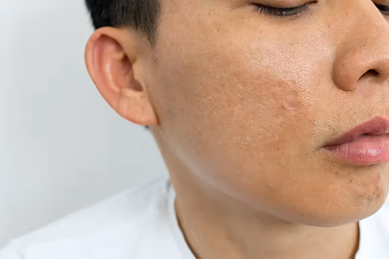 Acne scars Singapore | Types of Acne Scars & Marks Pico Fractional Laser Effectively Treat