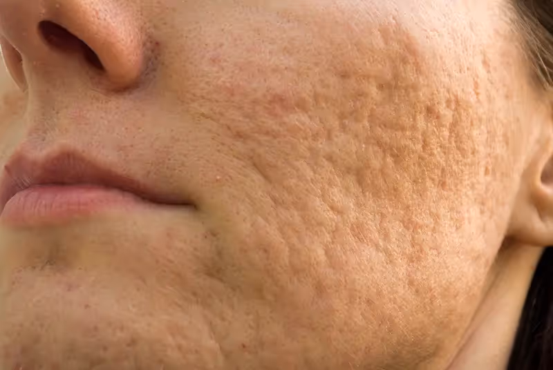 Boxcar Acne Scars Singapore | Types of Acne Scars & Marks 