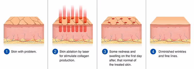 Fractional CO2 laser resurfacing: How it works