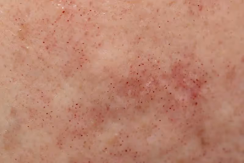 Close-up of the skin after picosecond laser treatment.