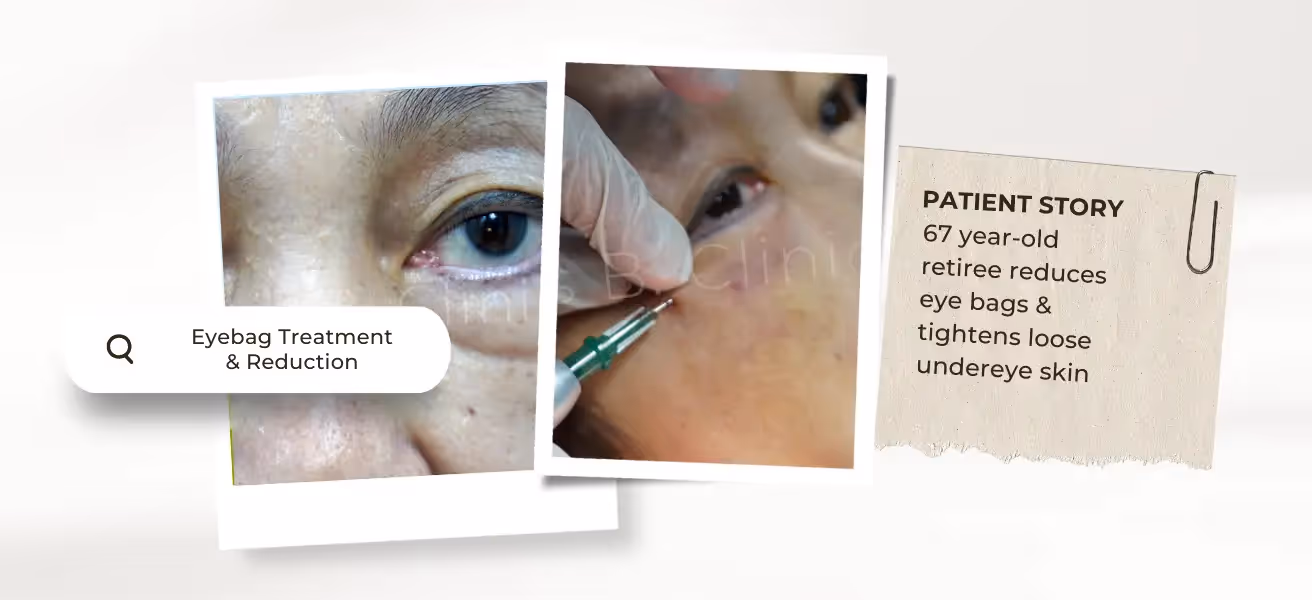 SD Micro-cannula Eye Bag RadioFrequency Treatment & RF Microneedling and Erbium Glass Laser