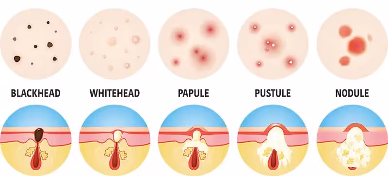 Acne types Singapore