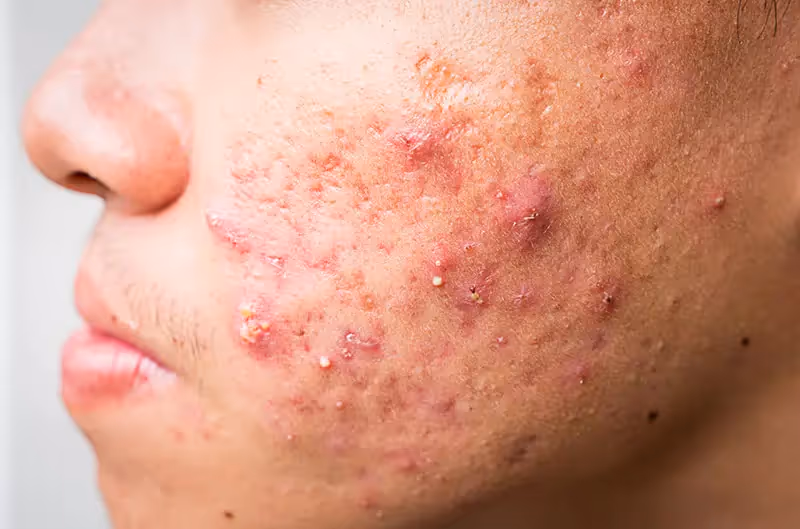 The psychological effect of acne on adults and teenagers, according to studies