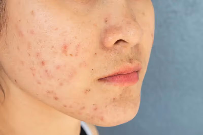 Acne Treatment at Amaris B. Clinic