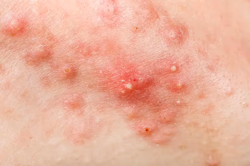 Acne Treatment at Amaris B. Clinic