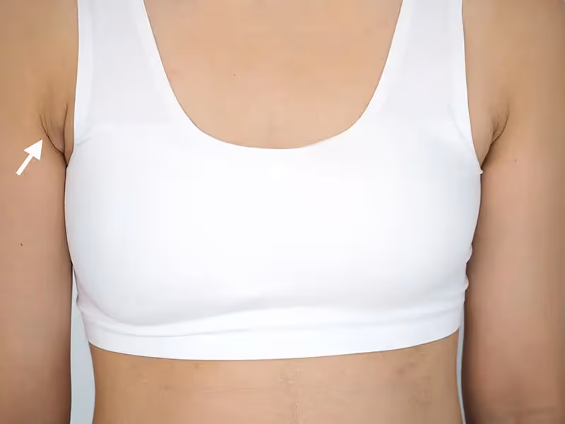Armpit Fat Axillary Singapore Liposuction Doctor