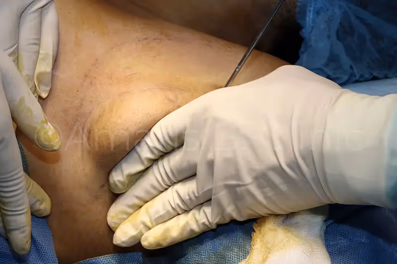 Armpit Fat Axillary Singapore Liposuction Doctor