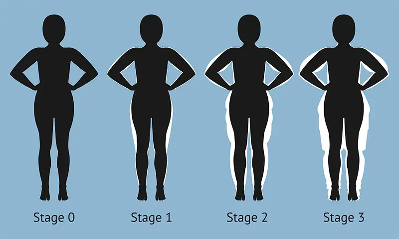Types and stages of Lipedema