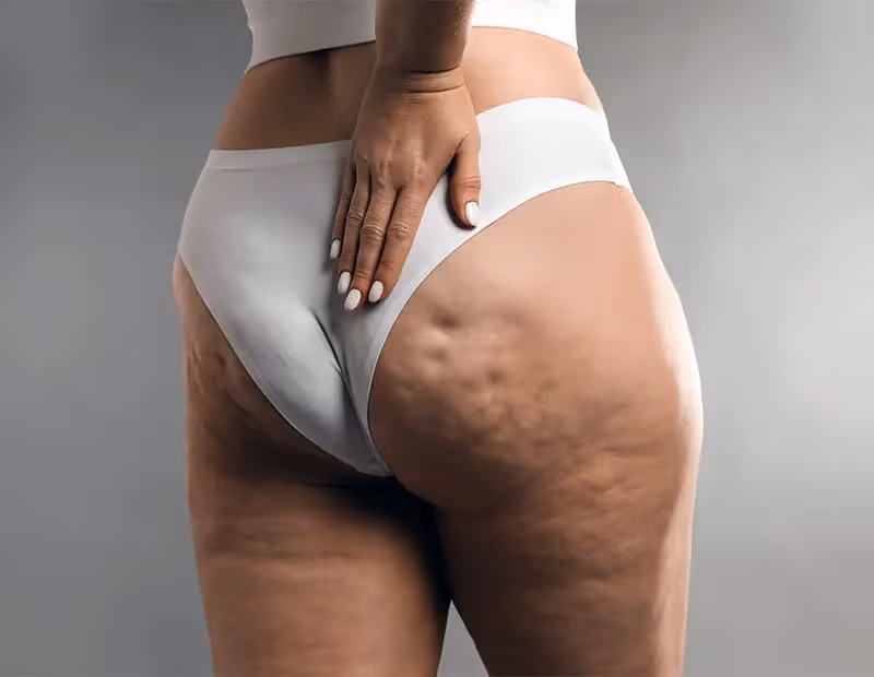 Characteristics of Lipedema