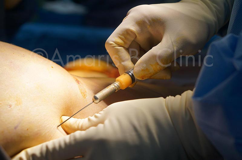 Dr. Ivan Puah during a buttock enhancement procedure