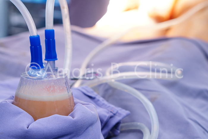Fat collected via VASER Lipo by Dr. Ivan Puah that will be separated and cleansed for fat grafting in Singapore 