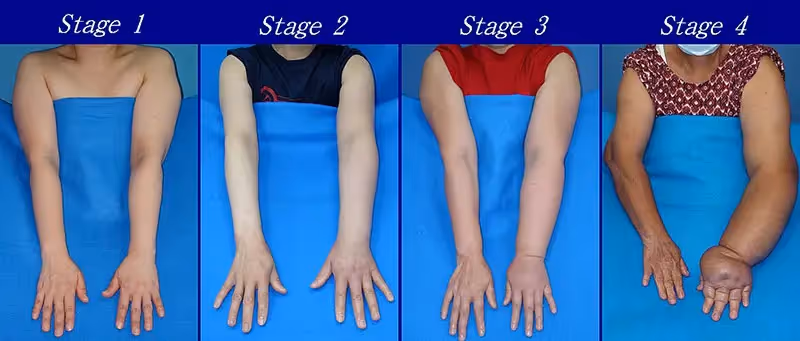 Lymphedema Grades & Stages in arms