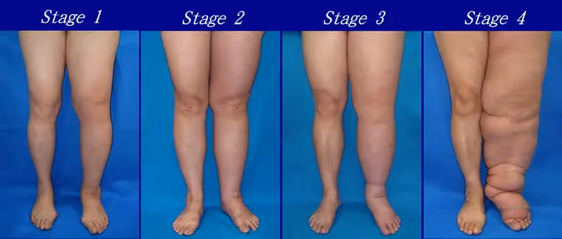 Lymphedema Grades & Stages in legs