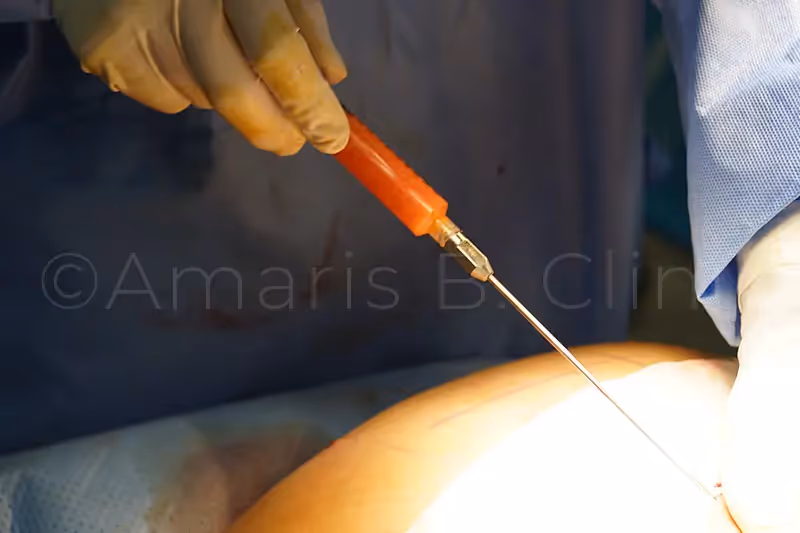 Buttock fat grafting Singapore